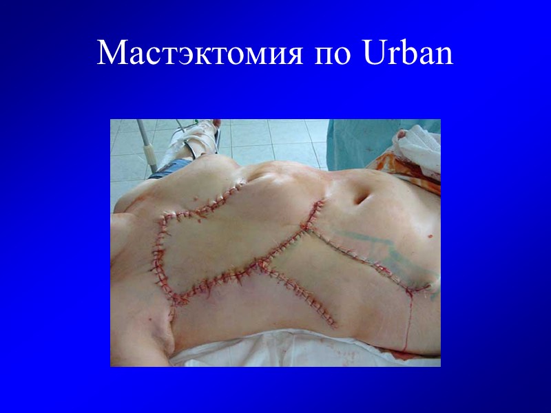 Мастэктомия по Urban